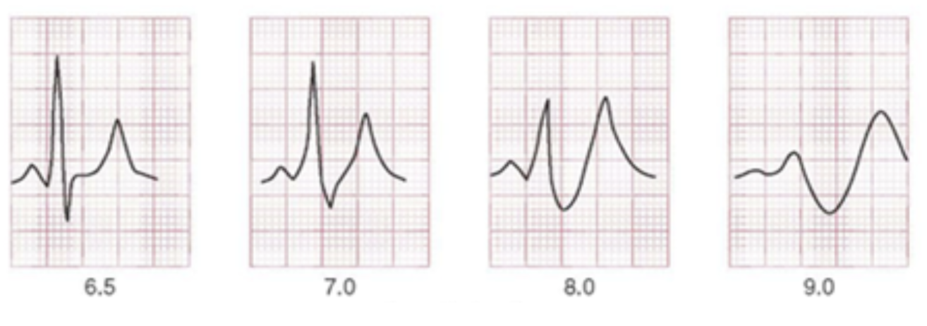 Severe hyperkalaemia Severe hyperkalaemia